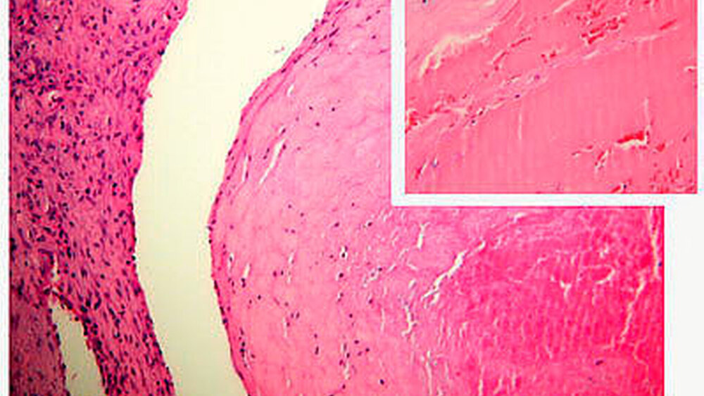 Abbildung 2: Ein fibrinreicher Thrombus erscheint nativ weißlich. In der histologischen Färbung ist das Fibrinnetz des Thrombus homogen, blassrot gefärbt und umschließt nur wenige Erythozyten. |