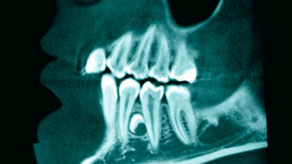 4d: Koronales Schnittbild bei 34+ mit Darstellung des linken Foramen mentale (Pfeil). |
