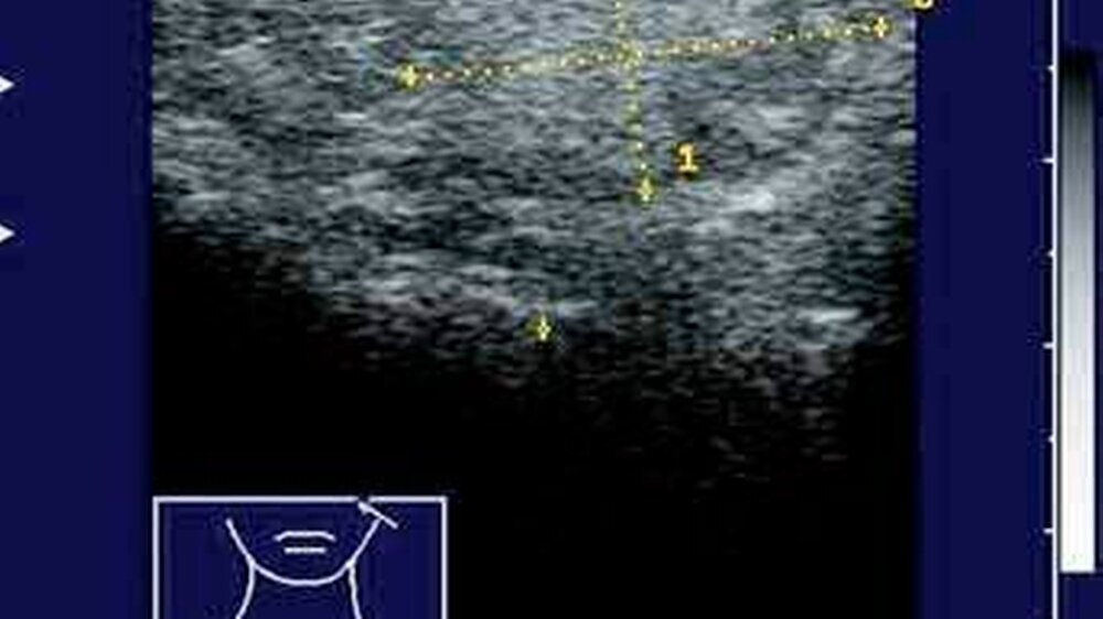 Abbildung 1: Sonographische Darstellung der Raumforderung in der linken Wange. Insbesondere der zentrale Anteil des Tumors weist in etwa die gleiche Dichte aus, wie das umgebende Fettgewebe.