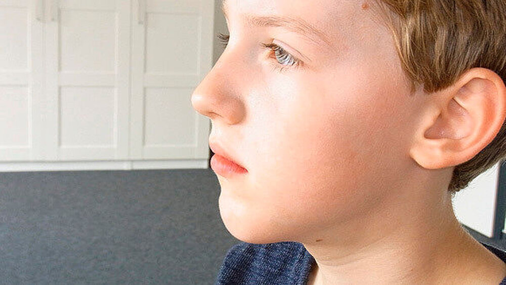 Abbildung 8: Mithilfe der IMT wurden eine physiologische Zungenruhelage und ein physiologisches Schluckbewegungsmuster eingestellt. Des Weiteren war eine positive skelettale Schädelentwicklung durch Mittelgesichtsentwicklung und ventrale Unterkieferentwicklung erkennbar. Parallel fand eine kieferorthopädische Behandlung statt. |
