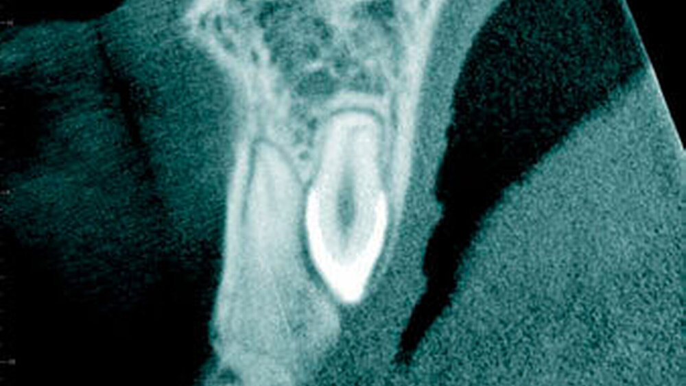 Abbildung 9: Überzähliger Zahn im Oberkieferfrontbereich (Mesiodens)mit einer konischen Form bei einem 14-Jährigen (b: sagittaler Schnitt) c: dreidimensionale Bildrekonstruktion). |