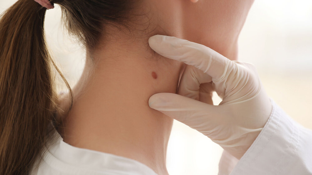 Dermatologist examining mole on young woman's neck in clinic, closeup Hautkrebs