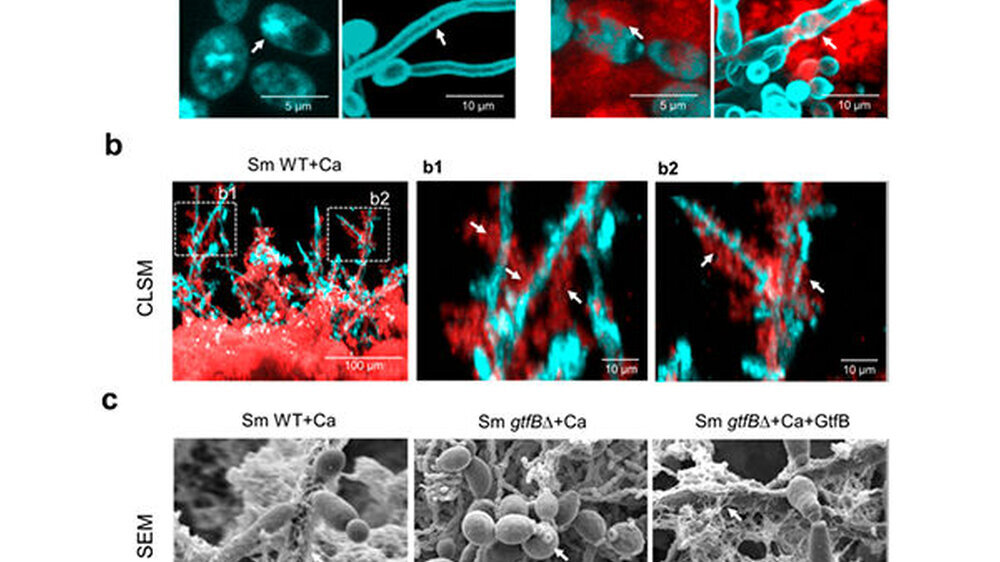 Die US-Studie zeigt, dass das von Streptococcus mutans hergestellte Enzym (GtfB) an Candida albicans binden kann. Wenn Zucker vorhanden ist, bildet sich auf seiner Zelloberfläche eine klebrige polymere Matrix, die es dem Pilz ermöglicht, sich mit bakter
