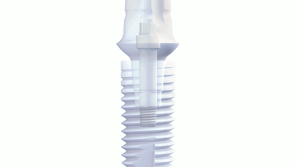 Z5-BL von Z-Systems – das erste verschraubte, zweiteilige Keramikimplantat mit konischer Verbindung.