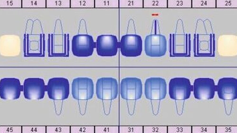 Abbildung 6: Schematisierte, grafische Planung (HighDent Plus, Systema Deutschland GmbH). |
