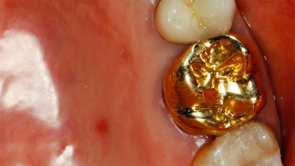 Mit welchem Okklusionskonzept lässt sich bei implantatgetragenem Zahnersatz unter Berücksichtigung der einwirkenden Kräfte eine möglichst gute Langzeitstabilität sicherstellen? Dr. Anna Kunzmann, Prof. Hans-Christoph Lauer und Dr. Sylvia Brandt, Fran Mit welchem Okklusionskonzept lässt sich bei implantatgetragenem Zahnersatz unter Berücksichtigung der einwirkenden Kräfte eine möglichst gute Langzeitstabilität sicherstellen? Dr. Anna Kunzmann, Prof. Hans-Christoph Lauer und Dr. Sylvia Brandt, Frankfurt, diskutieren die Taktilität dentaler Implantate und zeigen, wie osseointegrierte Implantate und Implantat-Abutment-Verbindung durch eine vorsichtige Modifikation der okklusalen Kaufläche geschützt werden können.
