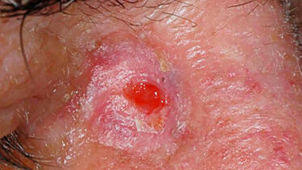 Abbildung 4: Zustand nach erfolgter Exzision und bereits eingesetzter Epithelialisierung der Wunde |