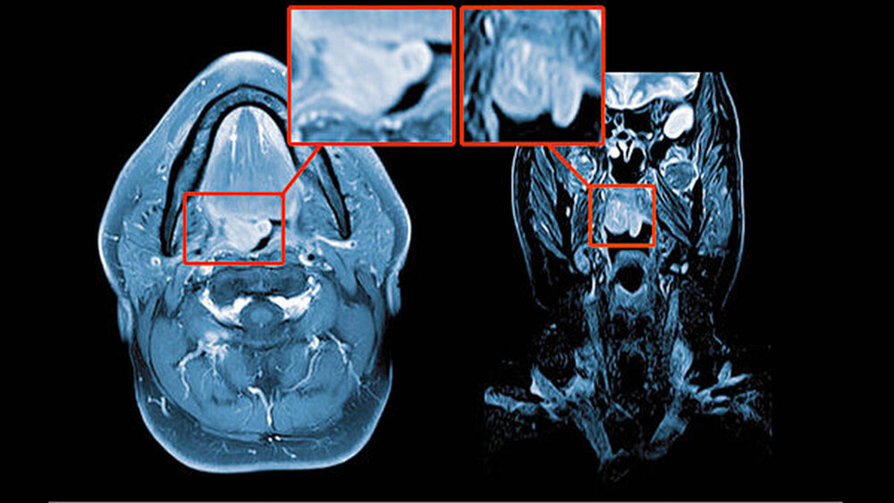 Abbildung 1: präoperativer Befund der Magnetresonanzuntersuchung (links T1-Gewichtung, rechts T2-Gewichtung) |