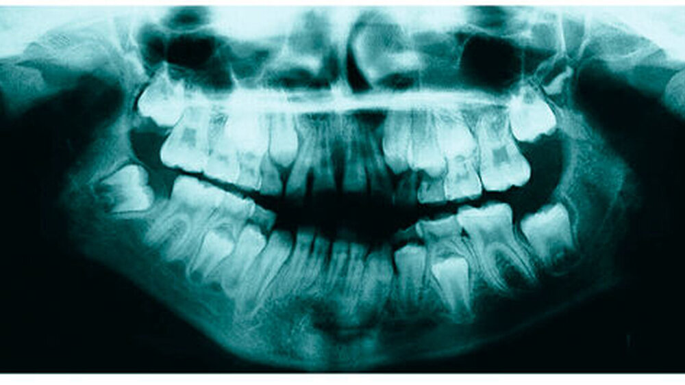 Abbildung 1 a: Größen- und Formveränderung des rechten Kondylus sowie abgeflachte Fossa, links ist der Kondylus unversehrt. |