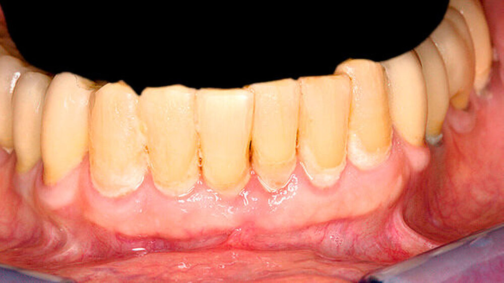 Abbildung 1: Ein häufiges Bild: Anzeichen einer marginalen Gingivitis im Mund des Patienten |