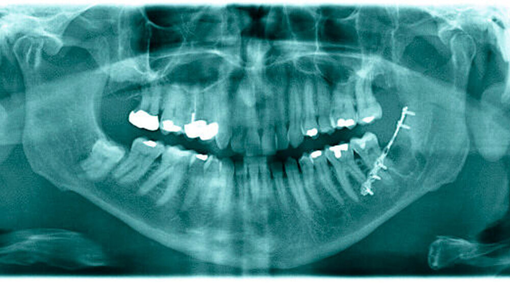 Abbildung 1: Postoperative Panoramaschichtaufnahme: Die analoge, präoperativ angefertigte Aufnahme zeigte aufgrund der geringeren Qualität keinerlei Anzeichen einer Fraktur. Auf der qualitativ deutlich besseren, allerdings postoperativ angefertigten Panoramaschichtaufnahme gibt es keinen sicheren Anhalt für eine Fraktur, nachdem der Patient beim Kauen das Krachen vernahm. |