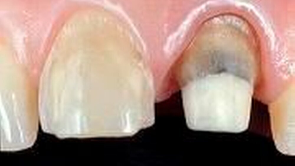 Abb. 1a: Präparation für ein Keramik-Veneer (Zahn 11) und für eine Vollkeramikkrone (Zahn 21). An Zahn 21 ist ein vollkeramischer Stiftaufbau adhäsiv befestigt.