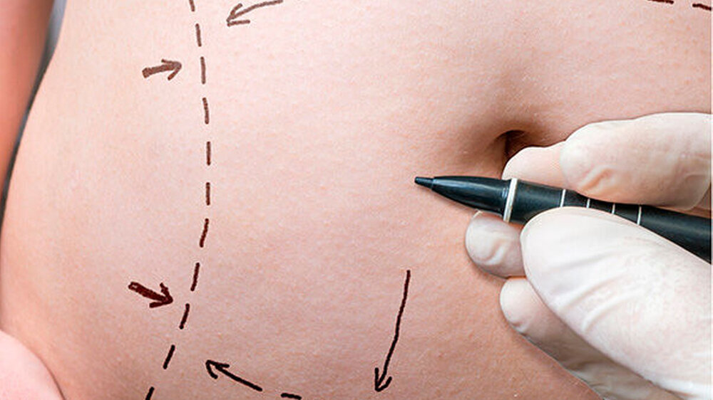 Krankenkassen sollen nach dem Willen von Bundesgesundheitsminister Jens Spahn (CDU) künftig die Kosten für eine Liposuktion zur Behandlung des Lipödems tragen, obwohl der Gemeinsame Bundesausschuss noch zu keiner abschließenden Nutzenbew