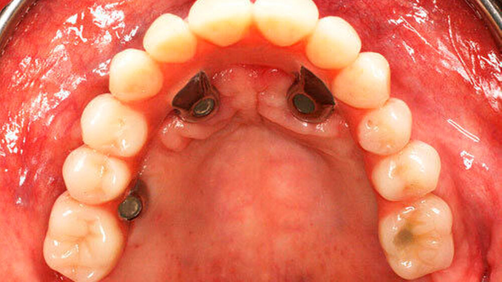 Abbildung 4 d) Basalansicht: Inkorporierter Zahnersatz. |
