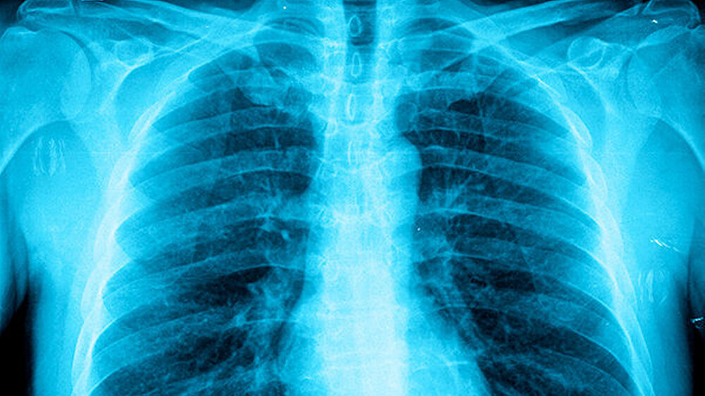 Handelt es sich um den Brustkorb einer asiatischen, hispano- oder afroamerikanischen Person? Die KI kennt die Antwort. Ist mit der medizinischen Bewertung der Röntgenaufnahme ein Bias verbunden, könnte dieser für Radiologen unsichtbar bleiben, befürch