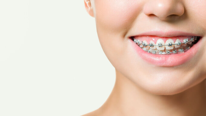 Orthodontic Treatment. Dental Care Concept. Beautiful Woman Healthy Smile close up. Closeup Ceramic and Metal Brackets on Teeth. Beautiful Female Smile with Braces