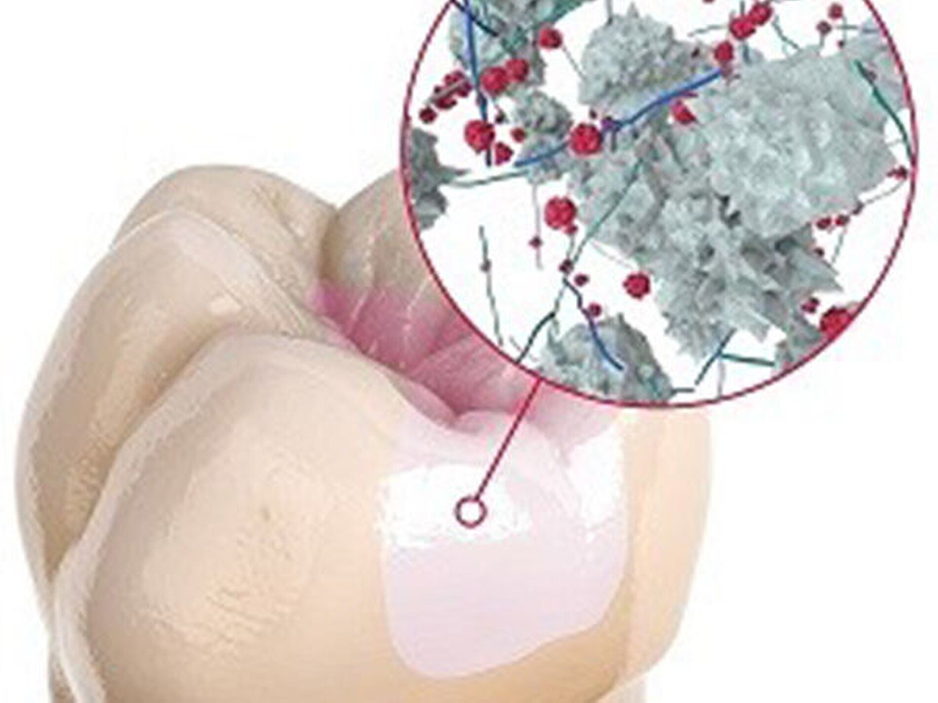 Die Suche nach einer AmalgamAlternative mit GlasHybrid