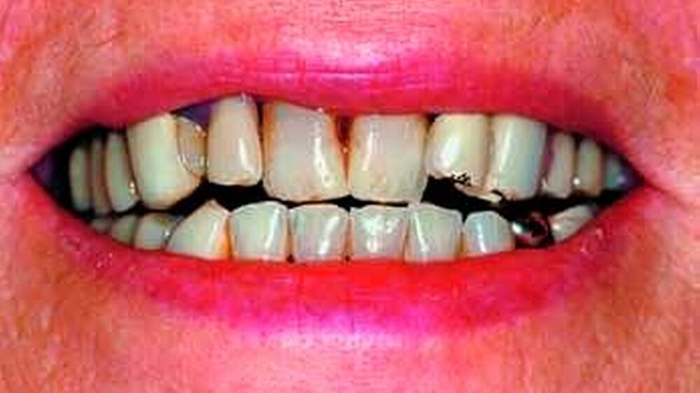 Gesundheitsnutzen von Zahnersatz durch Verbesserung von Funktion und Ästhetik: a: Ausgangssituation