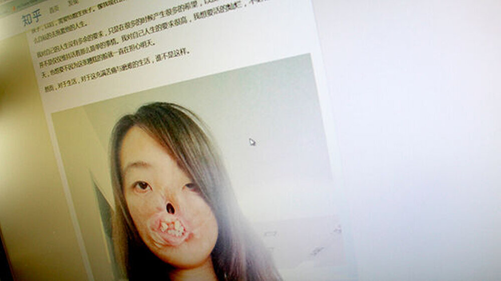 Mit ihrem Post auf der Website zhihu.com sorgte Jin Qui für eine "Internetsensation": Ganz China rührte ihre Leidensgeschichte - und ihre im Kontrast dazu stehende positive Lebenseinstellung.