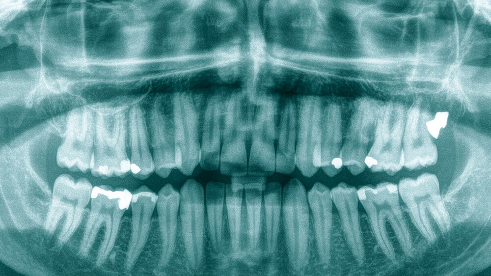 Abb. 1: Orthopantogramm des Patienten: Es kommt ein radiodenser Fremdkörper mit Projektion auf die distale Wurzel des Zahnes 27 zur Darstellung.