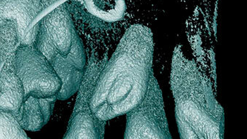 Abbildung 10: Überzähliger Zahn im Oberkieferfrontbereich (Mesiodens) vom tuberkulären (höckerförmigen) Typ bei einem zwölfjährigen Knaben (3-dimensionale Bildrekonstruktion). |