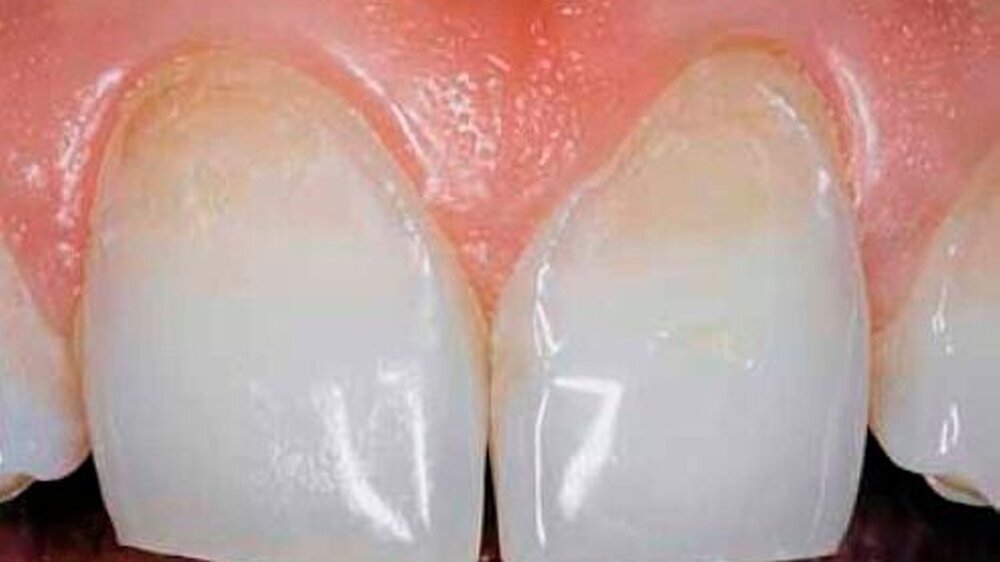 Abbildung 1: Zähne 11 und 21: Beide Zähne zeigen Erosionen mit Dentinbeteiligung. Die zervikale Schmelzleiste ist deutlich sichtbar.