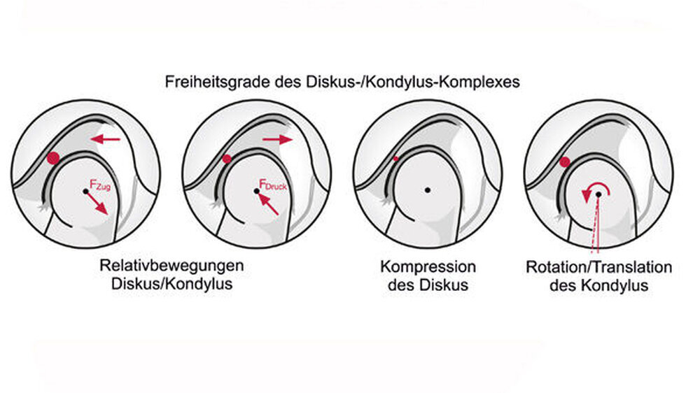 Abbildung 1: Konfiguration des Diskus als Ursache möglicher Distanzvariationen zwischen Fossa und Kondylus: Ausmaß der Rotation des Kondylus um die Scharnierachse bei 4 mm frontaler Öffnung circa 2 bis 4 Grad.