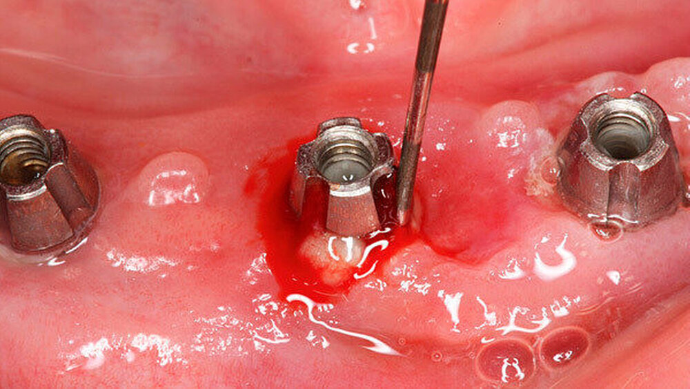Klinische Anzeichen einer etablierten Periimplantitis (BOP, Pus und Pocketing) |