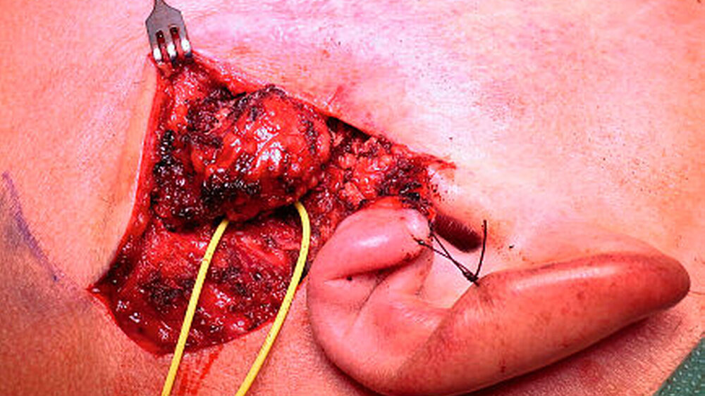 Abildung 4: Intraoperativer Situs |