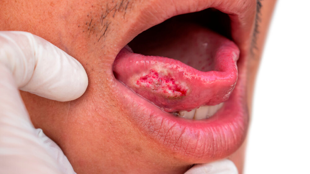 Squamous cell carcinoma of tongue. Oral cancer or malignant tumor. Squamous cell carcinoma of tongue. Oral cancer or malignant tumor of Asian male patient.