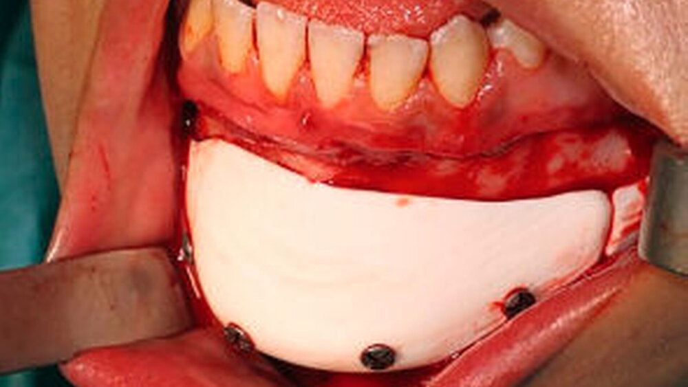 Abbildung 4: Intraoperative Situation mit dem mit Schrauben fixierten individuellen Bioverit®II-Implantat |