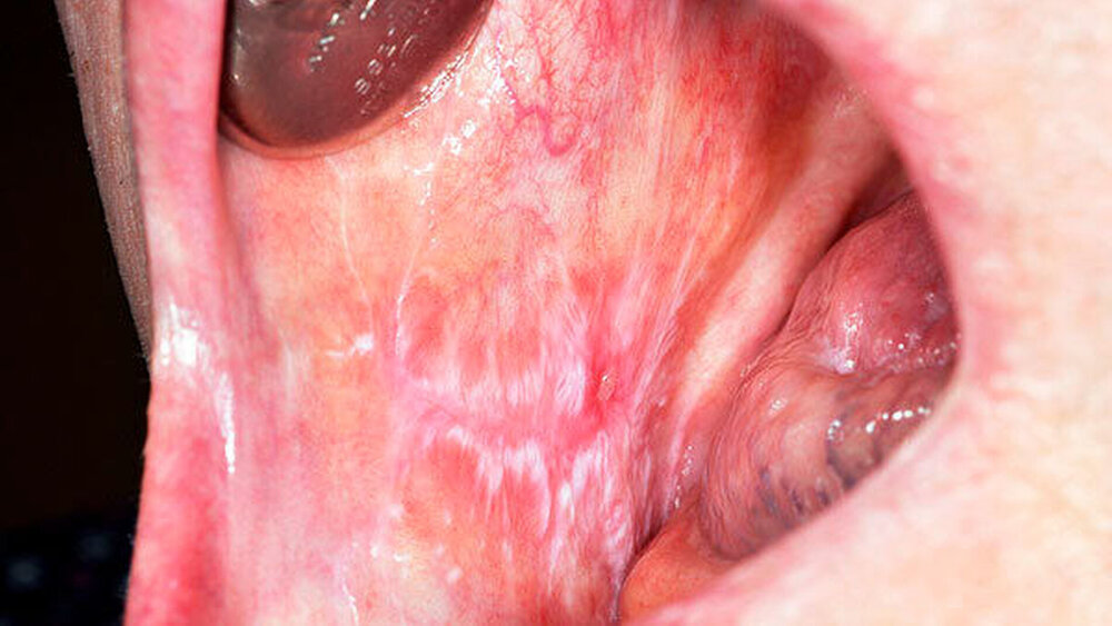 Abbildung 3: Bei einem immunsupprimierten Patienten hat sich auf der buccalen Schleimhaut ein Lichen ruber planus ausgebreitet. |
