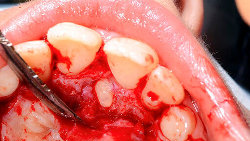 3i: Palatinale Lappenbildung mit Osteotomie zur Darstellung des Mesiodens. |