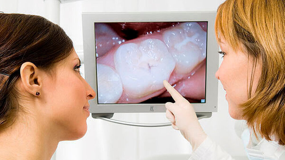 Die Fissurenversiegelung ist laut DGZ und DGZMK eine empfehlenswerte Maßnahme, um Karies der Okklusalflächen zu verhindern. |