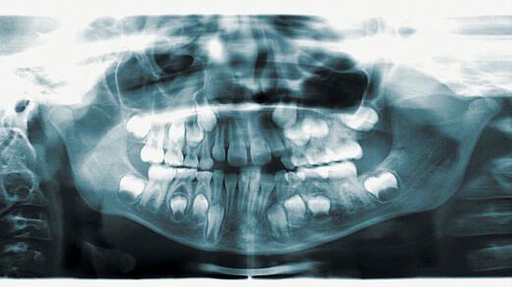Nichtangelegte bleibende Zähne wären unter zahnrztlichen Gesichtpunkten betrachtet eine Indikation für eine endodontische Therapie im Milchgebiss. | Nichtangelegte bleibende Zähne wären unter zahnrztlichen Gesichtpunkten betrachtet eine Indikation für eine endodontische Therapie im Milchgebiss. |