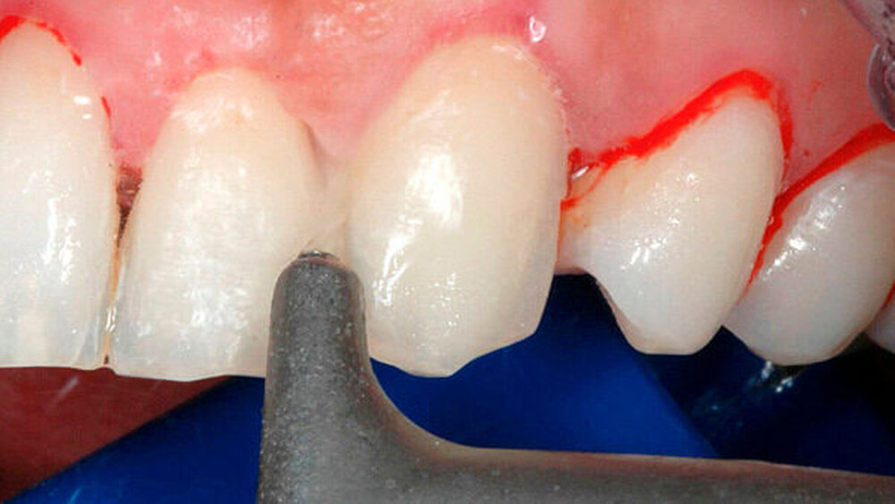 Abbildung 3: Subgingivales Pulverstrahlen am Zahn: Um ein optimales Ergebnis zu erzielen, sollte die Düse im Abstand von etwa 5 mm unter ständiger Bewegung etwa parallel zur Zahnachse gehalten werden. |