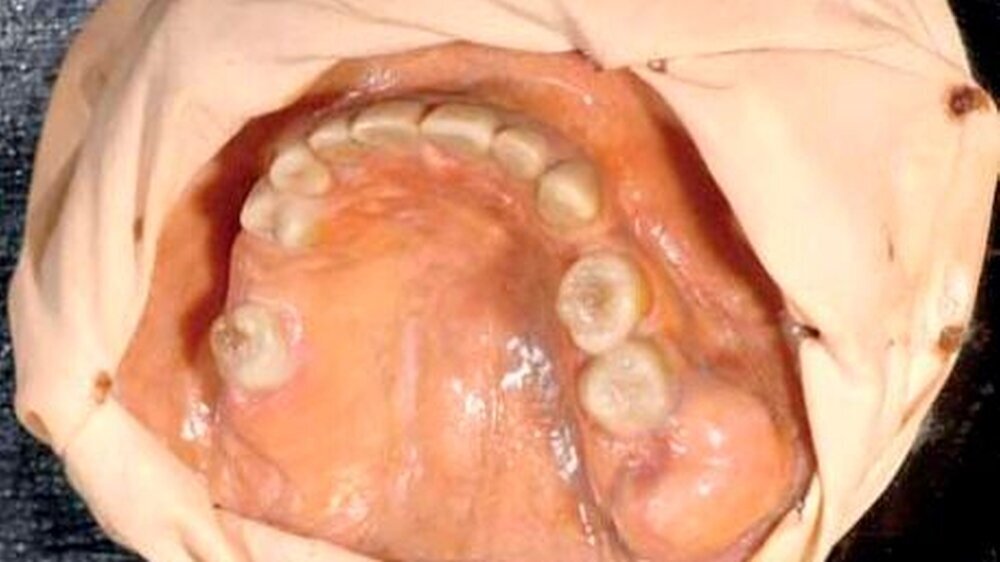 Osteoma maxillae, hergestellt von Lotte Vogler um 1920 in der Chirurgischen Klinik des Kantonspittals Zürich