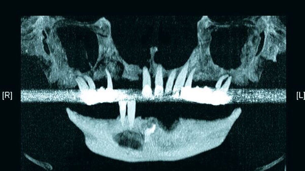 Abbildung 1: Präoperative OPG-Rekonstruktion aus dem CT: zystische Läsion mit Wurzelrest im vierten Quadranten, horizontaler Knochenabbau im Oberkiefer mit osteolytischen Prozessen. |