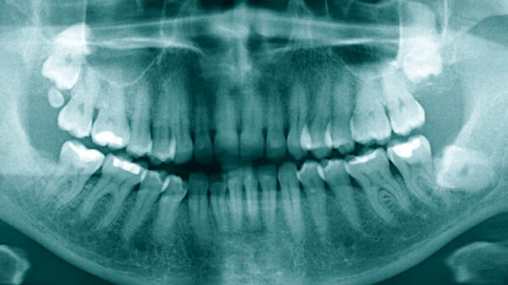 Abb. 1: In der vorliegenden Panoramaschichtaufnahme ist der Zustand nach Osteotomie des Zahnes 48 zum Zeitpunkt der Erstvorstellung der Patientin in der Klinik und Poliklinik für Mund-, Kiefer- und Gesichtschirurgie der Universitätsmedizin Mainz dargest