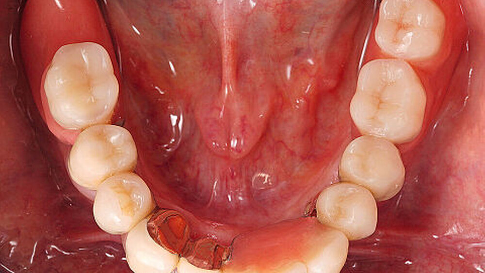 Abbildungen 6 und 7: Im Unterkiefer wurden zwei Implantate mit vier natürlichen Zähnen kombiniert. Die Versorgung erfolgte mit einer klassischen Teleskopversorgung. |