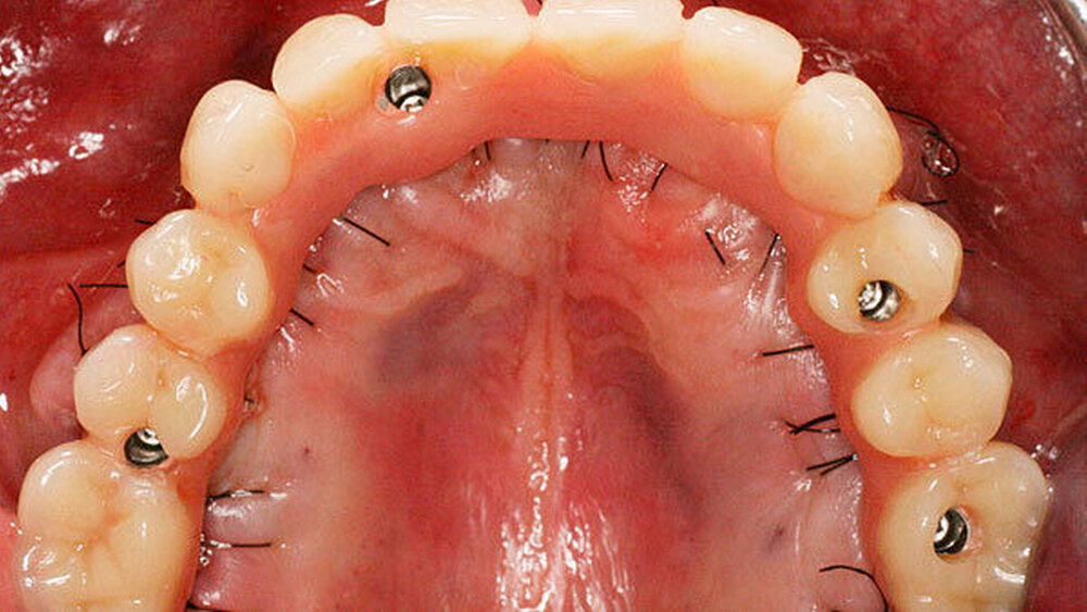 Abbildung 1c) Basalansicht: Eingliederung eines festsitzenden Zahnersatzes am Folgetag nach dem operativen Eingriff. Der Zahnersatz ist okklusal mit den Implantaten verschraubt. |