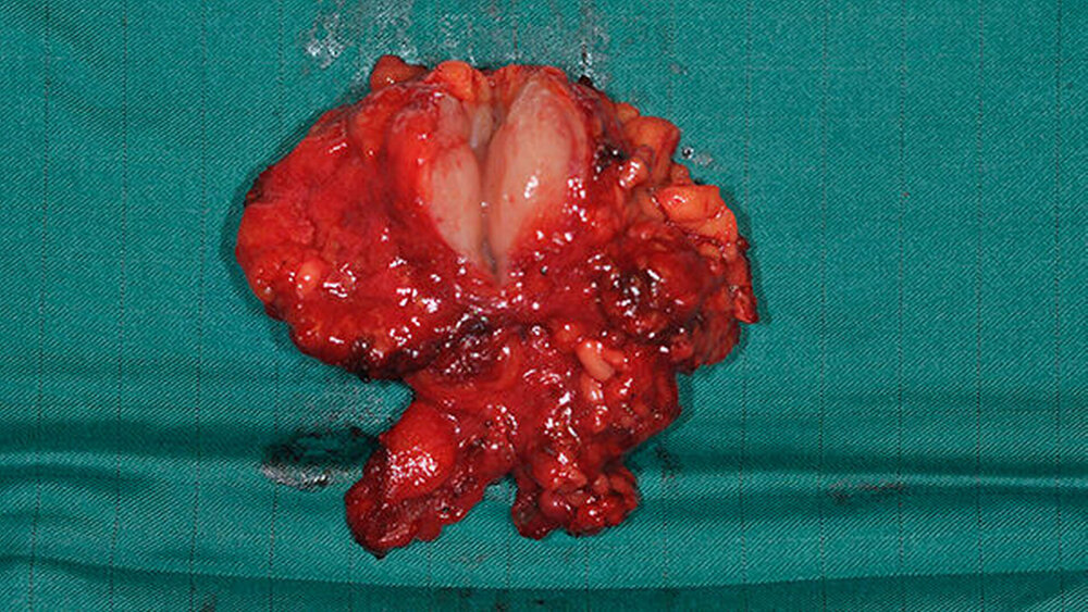 148641-flexible-1900 Die Abbildung zeigt das resezierte B-Zell-Lymphom. Ursprünglich war die Wange nur geschwollen, aber dahinter war etwas Ernsteres verborgen. |