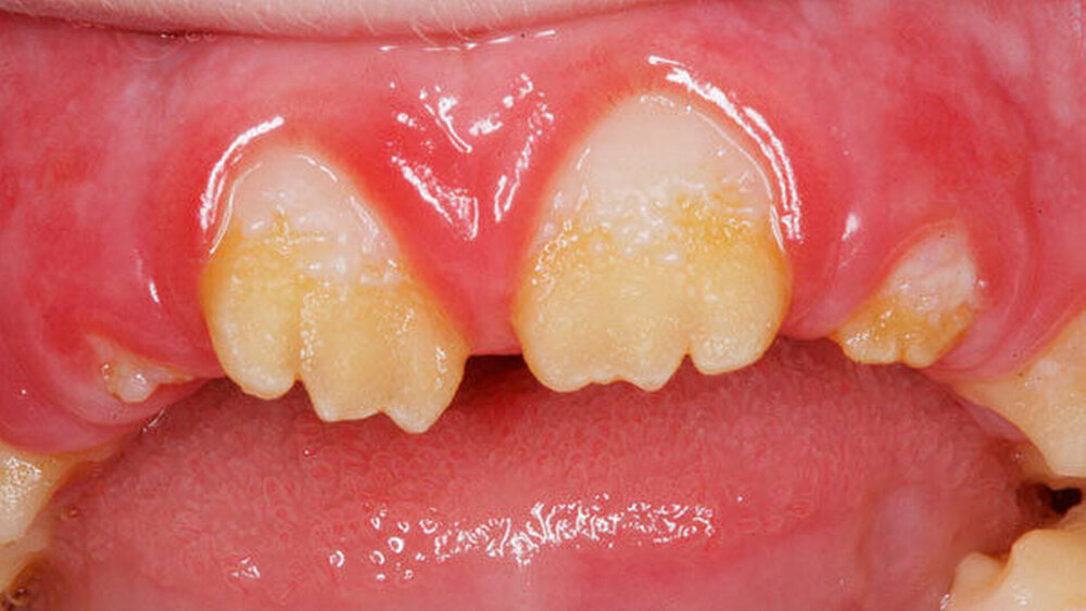 2b: Nahaufnahme der oberen Frontzähne. Deutlich ersichtlich ist die Schmelzdysplasie bei intaktem Dentin. |