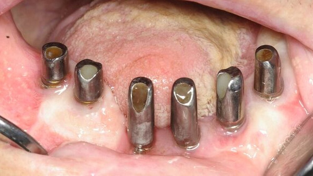 Abbildung 18: Titanabutments im Recall zwei Jahre nach Eingliederung: Die Implantate weisen keine erhöhten Sondierungstiefen auf. |