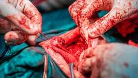 Tongue tumor removal by oral surgeons in hospital