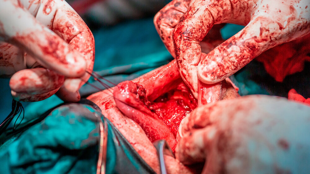 Tongue tumor removal by oral surgeons in hospital