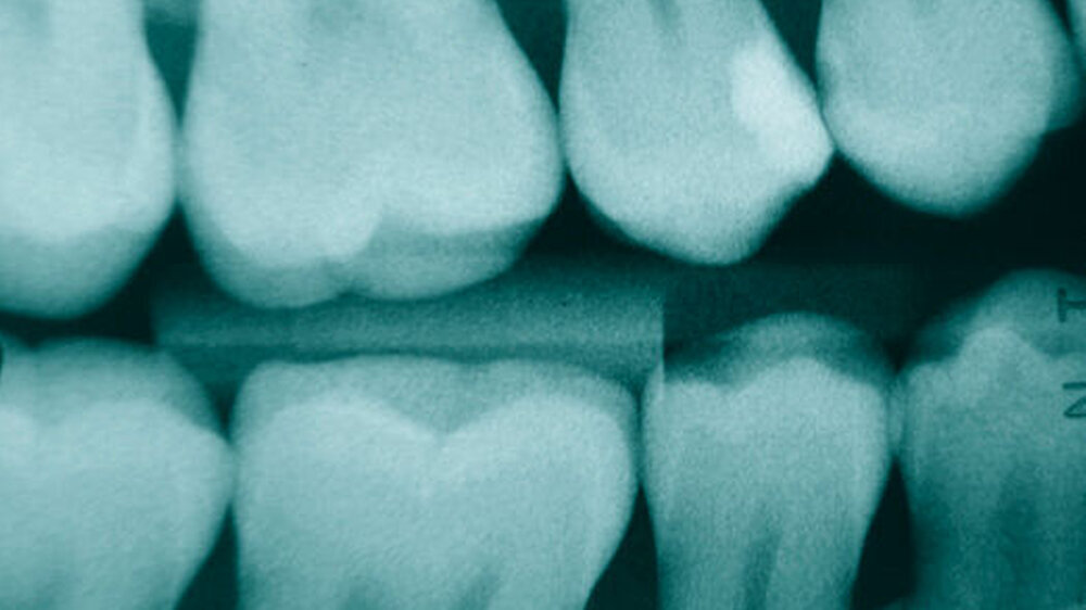 Abb. 1: Karies an Zahn 14 distal. Röntgenologisch sieht man eine Dentinbeteiligung im äußeren Dentindrittel, aber eine Kavität an sich erkennt man nicht. |