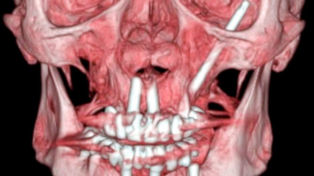 CT-Darstellung Knochenfenster und 3-D-Rekonstruktion