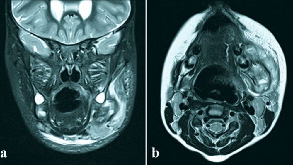 Abbildungen 1a: Coronar (T2 gewichtet), 1b: Axial (T2 gewichtet): Die Kernspintomografie zeigt ‧eine tumorsuspekte Raumforderung im Bereich des Kieferwinkels links mit Kortikalisdestruktion.