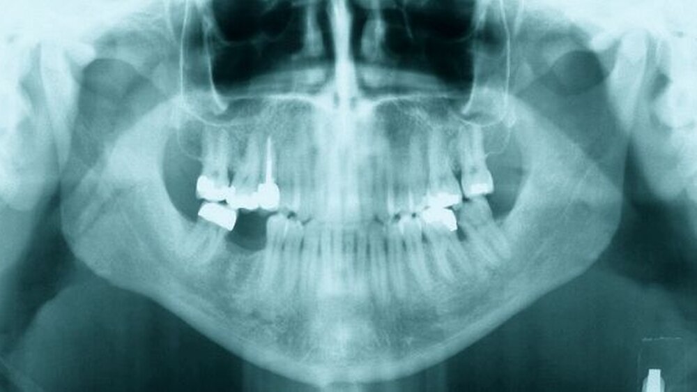 Abbildung 1: OPG zum Zeitpunkt des ersten Zahnarztbesuches: tiefe Karies mesial am Zahn 37 mit apikaler Parodontitis der mesialen Wurzel; angedeutet bereits eine unscharf begrenzte periapikale Radioluszenz mit vermehrter Opazität im Randbereich